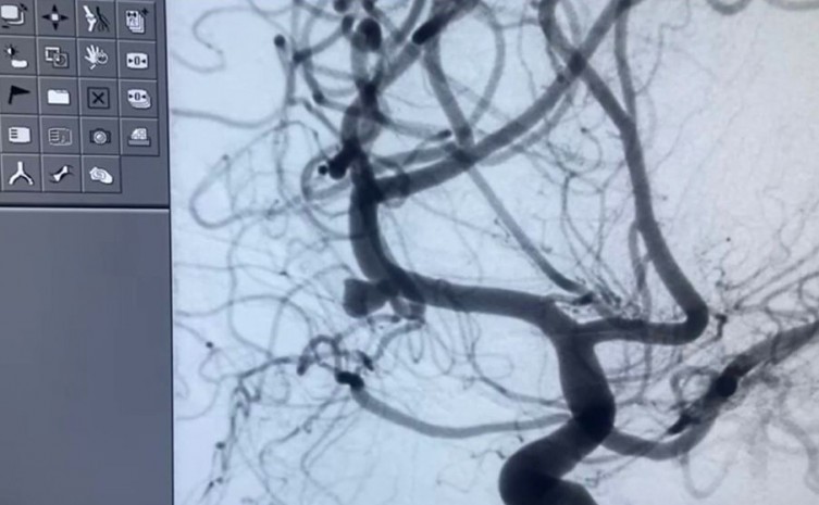 HGP destaca saldo positivo de procedimento inovador na área de neurocirurgia