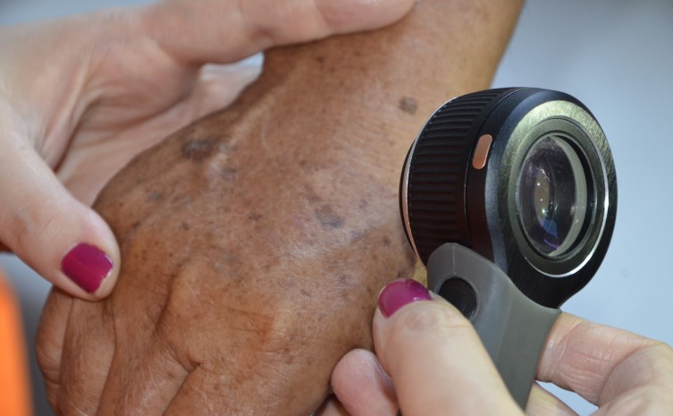 Saúde incentiva campanha para prevenção e diagnóstico precoce do câncer de pele